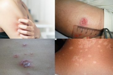 skin_lesion1